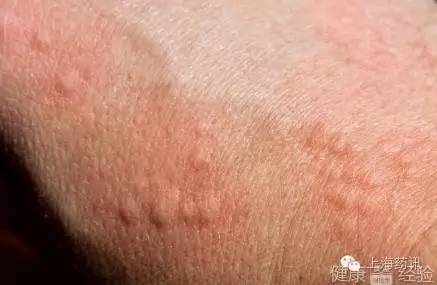 以前使用头孢、青霉素类药物过敏了,现在还能用吗?