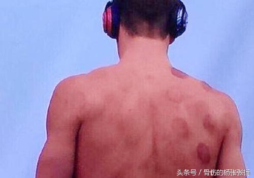 奥运会拔罐效果,里约奥运会拔火罐图