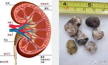 输尿管排尿慢膀胱有问题,尿尿慢有可能输尿管狭窄吗