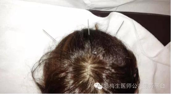 董氏奇穴治疗带状疱疹后遗症,董氏奇穴全身痒