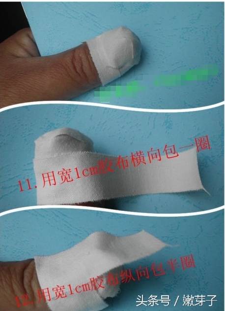 灰指甲包甲步骤及用药