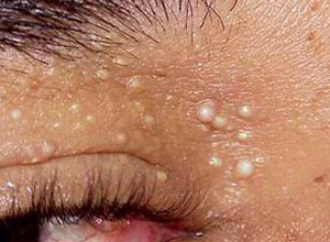 眼睛周围长出的这些小米粒儿,到底是什么呢?