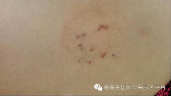 董氏奇穴治疗带状疱疹后遗症,董氏奇穴全身痒