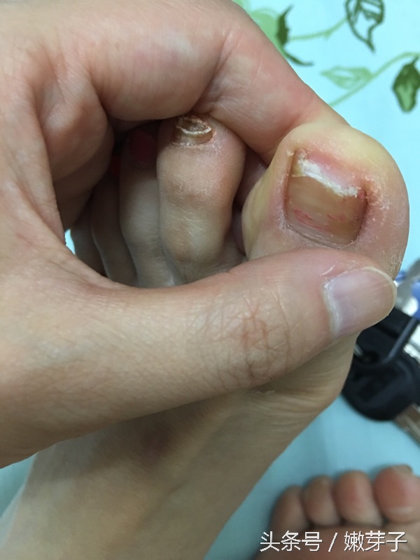 治疗灰指甲过程中需忌口吗,治灰指甲有几个阶段