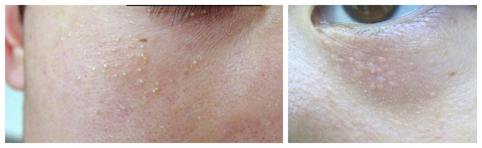 眼睛周围长出的这些小米粒儿，到底是什么呢？