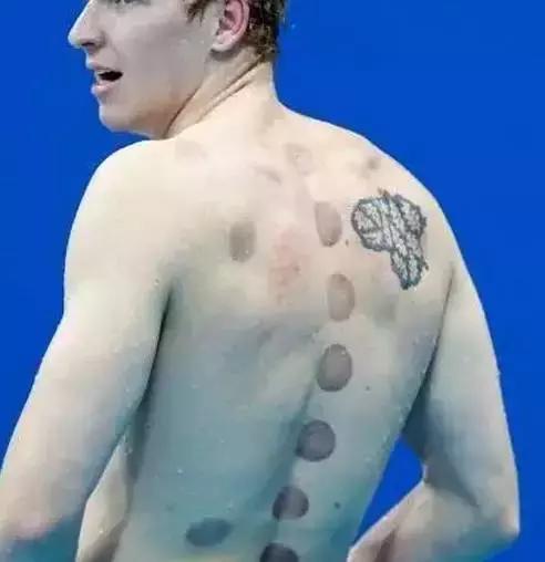 拔火罐火到国外,拔火罐风靡世界