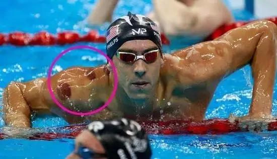 拔火罐火到国外,拔火罐风靡世界