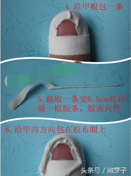 灰指甲包甲步骤及用药