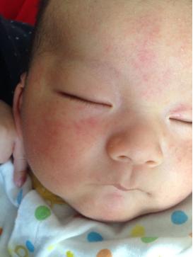 宝宝长湿疹的原因及护理方法,宝宝患湿疹的症状和治疗方法