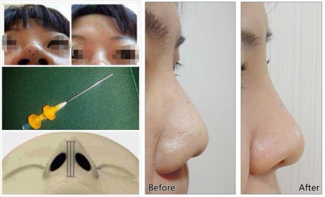 埋线鼻子vs假体隆鼻,隆鼻假体和埋线隆鼻