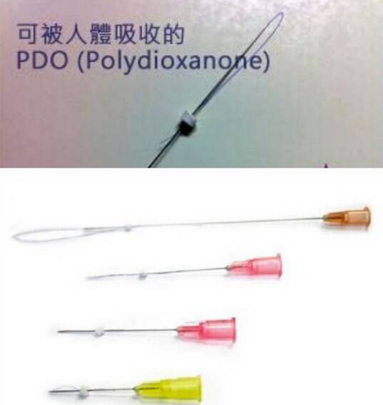 埋线鼻子vs假体隆鼻,隆鼻假体和埋线隆鼻