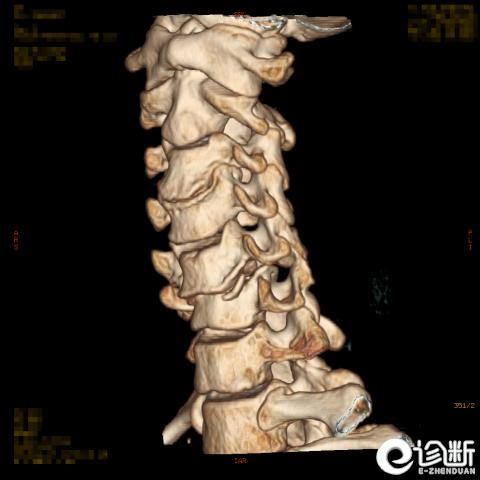 最严重颈椎骨折怎么治疗,ai诊断肋骨骨折