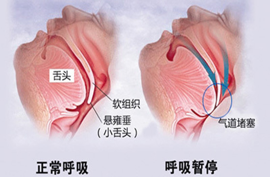 睡觉打鼾严重憋气视频,一男子打鼾一夜呼吸暂停近300次