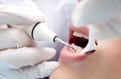 洗牙后注意的事项,洗牙后怎样护理不长牙结石