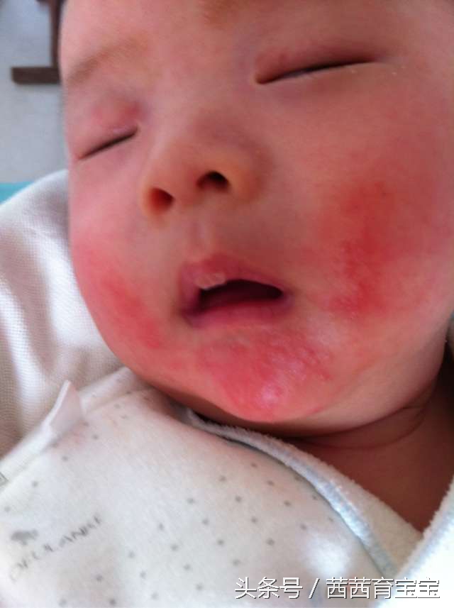 宝宝长湿疹是因为热吗,宝宝屁屁长湿疹怎么办