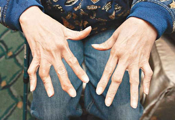 类风湿性关节炎有并发症怎么办,自身免疫性肝炎和类风湿关节炎