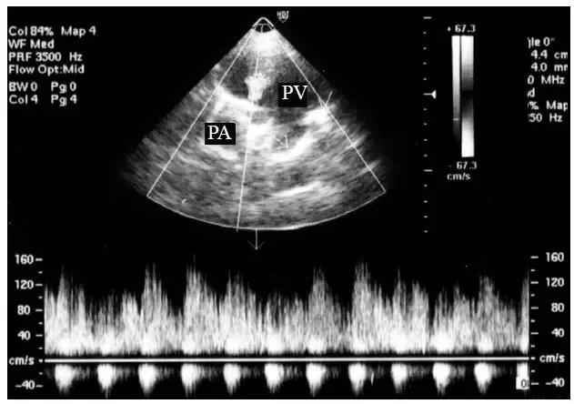 动静脉瘘超声频谱特征,超声动静脉瘘的描述