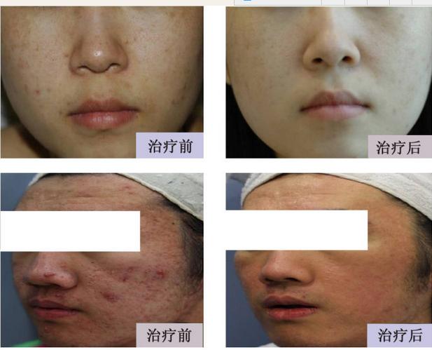 选什么美容仪比较好,美容专用电动微针全过程