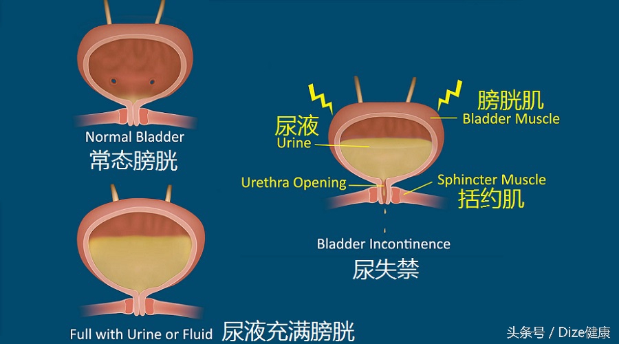 憋尿会把膀胱憋爆吗,憋尿会导致膀胱炸裂吗