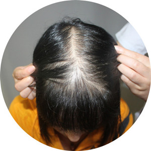 脂溢性脱发到底是什么原因引起的,脂溢性脱发到底是哪里出现问题