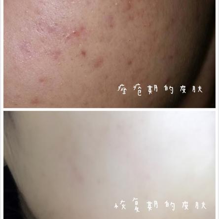 长过痘痘的肌肤怎么修护,长过痘的皮肤如何修复