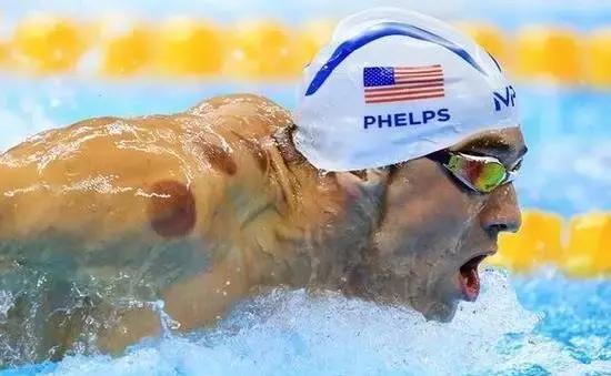 拔火罐火到国外,拔火罐风靡世界