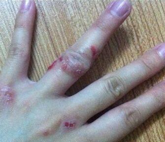 湿疹是不是春天高发,湿疹经常做这些事好得快