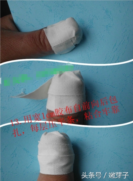 灰指甲包甲步骤及用药