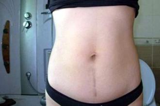 剖宫产夏天坐月子的注意事项,剖宫产夏天怎么坐月子