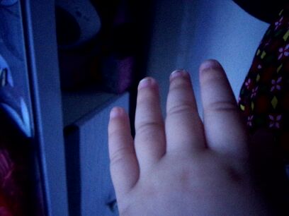 宝宝甲沟炎严重导致指甲剥离,宝宝甲沟炎需要剪指甲吗