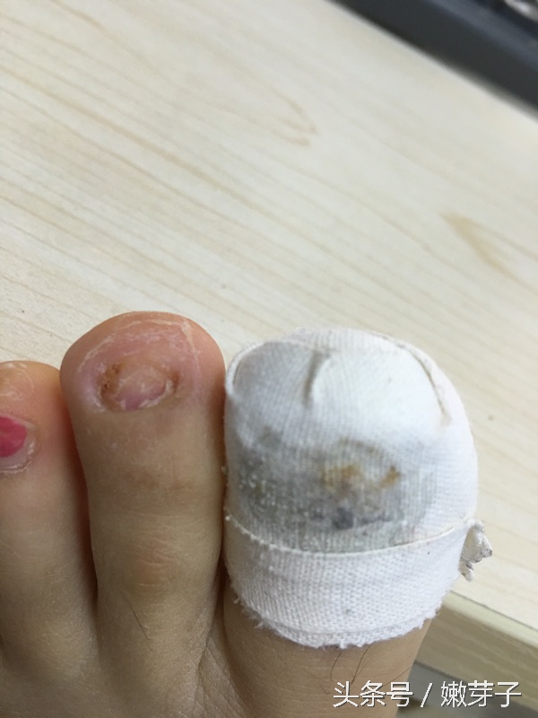 治疗灰指甲过程中需忌口吗,治灰指甲有几个阶段