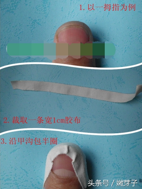 灰指甲包甲步骤及用药