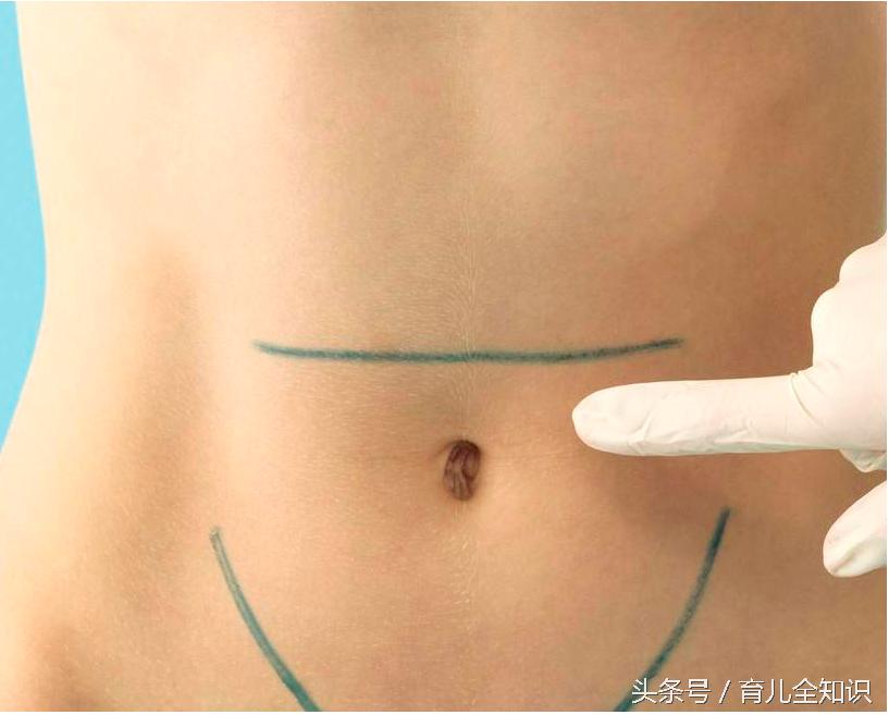 顺产VS剖腹产对身体的种种影响，你会如何选择?