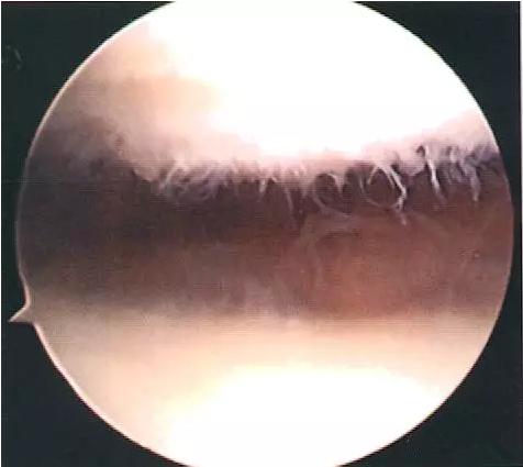 不能轻视的膝关节运动损伤:髌骨软化症