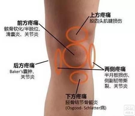 不能轻视的膝关节运动损伤:髌骨软化症
