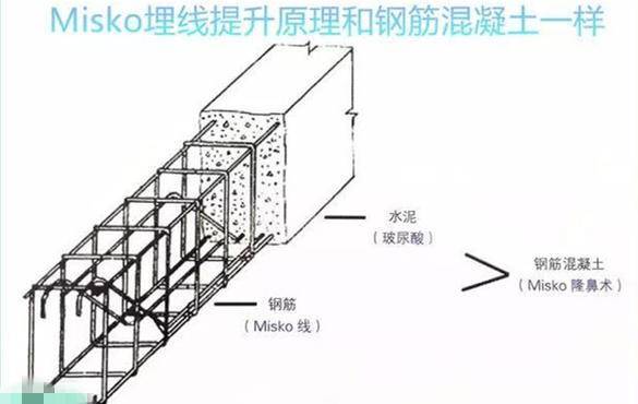 埋线鼻子vs假体隆鼻,隆鼻假体和埋线隆鼻
