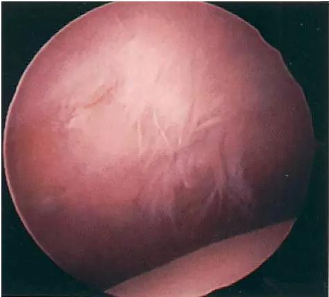 不能轻视的膝关节运动损伤:髌骨软化症