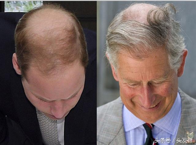 秃顶是什么遗传方式,秃顶是什么原因造成的女生