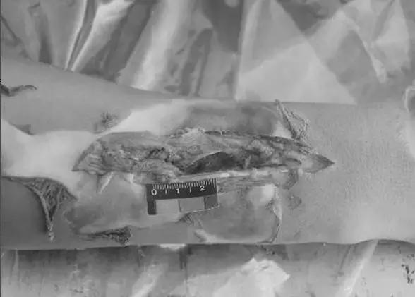 中暑会不会出人命,中暑严重会出人命吗