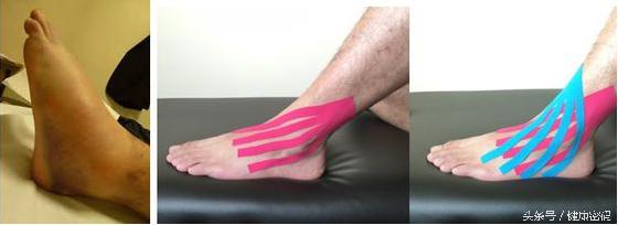 脚踝扭伤了不能走路怎么恢复最快,脚踝扭伤影响运动功能吗