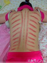 秋天感冒发烧喉咙痛应该怎么办,秋季感冒喉咙痛最快最好方法