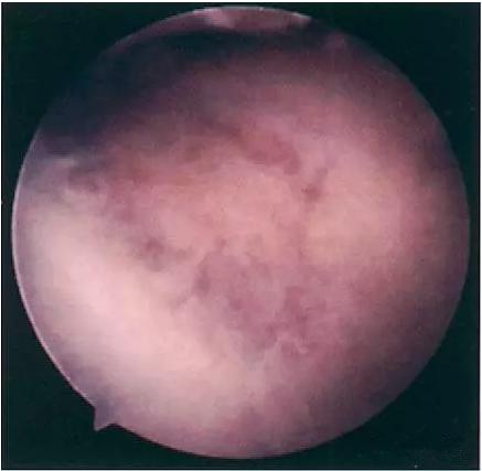 不能轻视的膝关节运动损伤:髌骨软化症