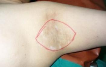 何氏狐臭净能根除轻微腋臭吗,腋臭治疗费用一览表狐臭能根除吗