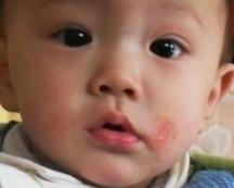 儿童湿疹引起皮肤溃烂怎么办,婴儿皮肤湿疹怎么处理