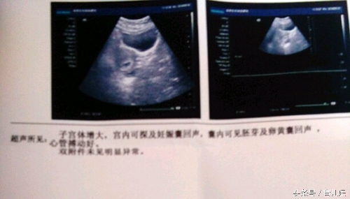 孕酮低五周没看到胚芽正常吗,孕酮低打黄体酮也不长怎么办