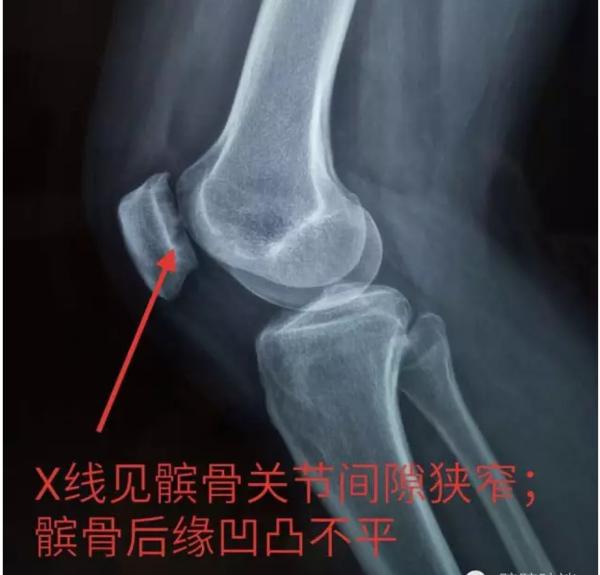 不能轻视的膝关节运动损伤:髌骨软化症