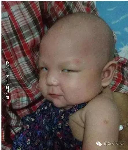 小孩长湿疹需要怎么处理,小孩长湿疹最好的处理方法