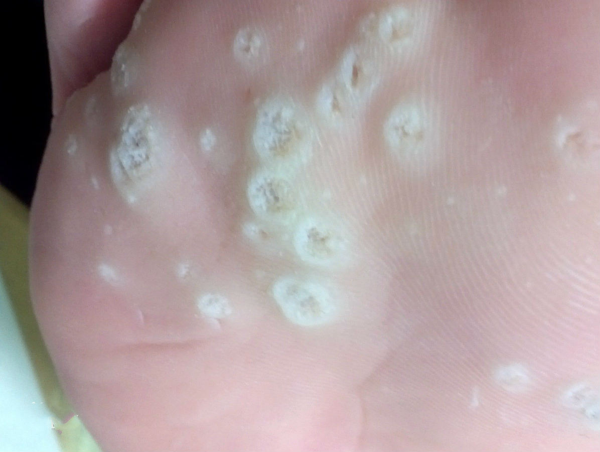 hpv也会感染到膀胱吗,HPV很容易传染吗