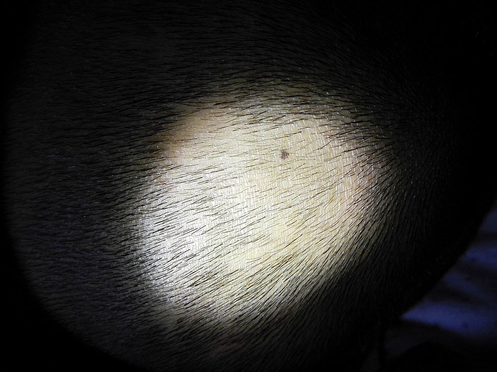 22岁小伙因斑秃或失女友，15年专家临床经验倾囊相授辩证施治