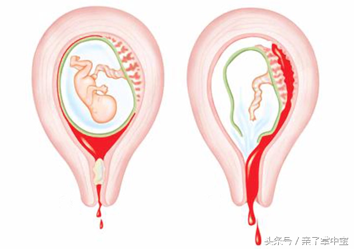孕妇被逼吃催生药要生了,孕妇生产不听医生劝阻吃了催生药